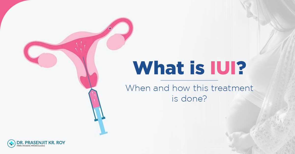 When And How IUI Treatment is Done?